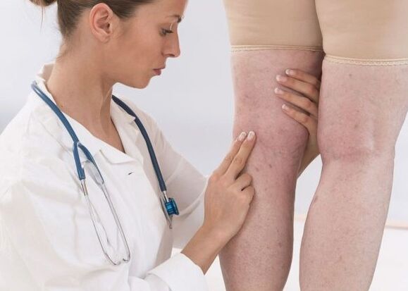 Diagnosticul venelor varicoase