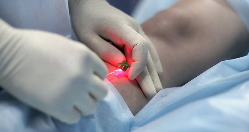 Tratamentul chirurgical al venelor varicoase